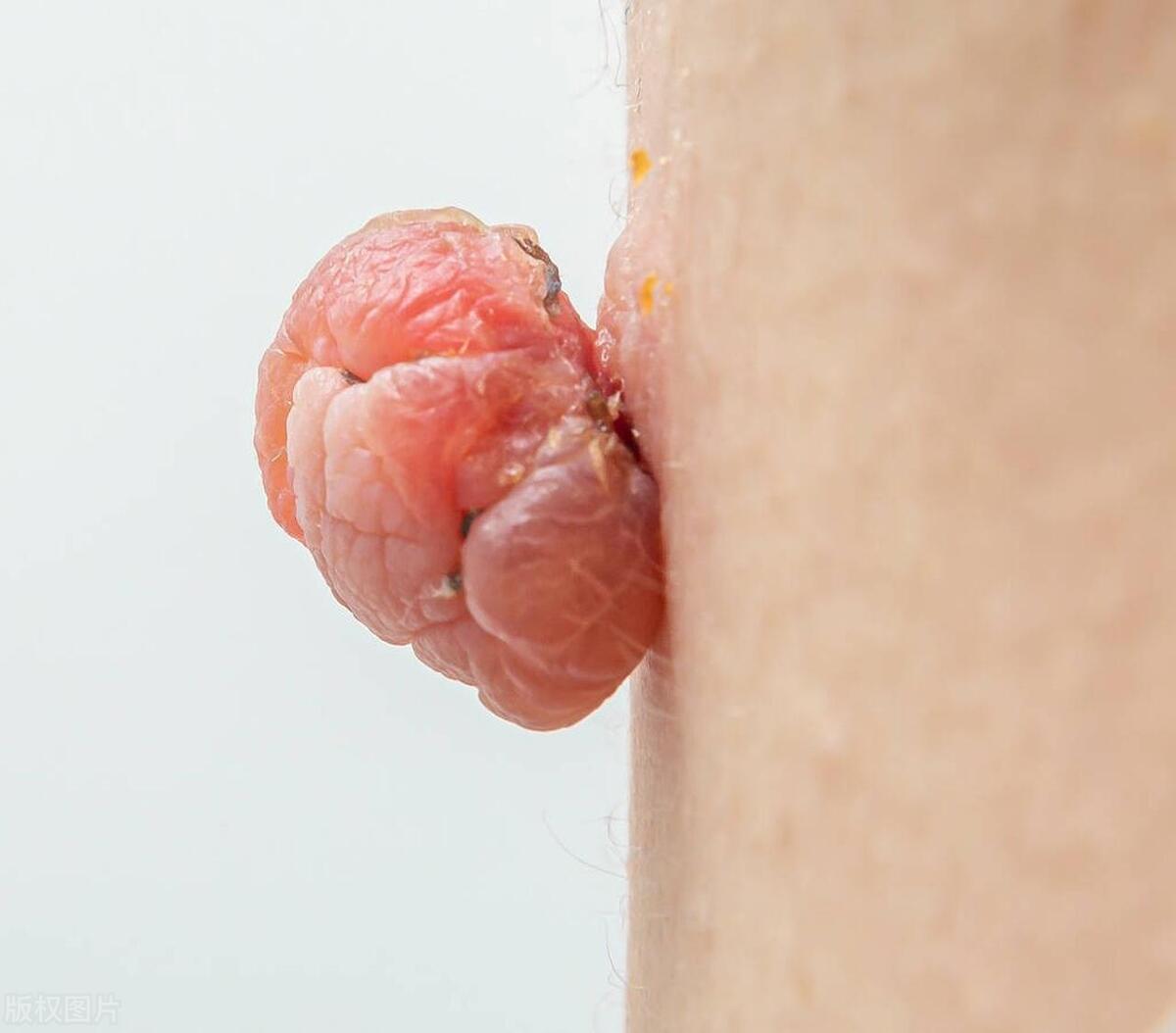 梅毒的潜伏期有多长时间 梅毒的潜伏期是多久?什么症状?(图1)